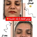 فیشیال صورت