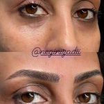 میکروبلیدینگ و فیبروز ابرو