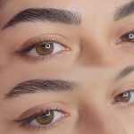 میکروبلیدینگ و فیبروز ابرو