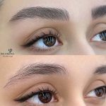 میکروبلیدینگ و فیبروز ابرو