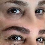 میکروبلیدینگ و فیبروز ابرو