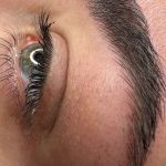 میکروبلیدینگ و فیبروز ابرو