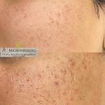 میکرونیدلینگ