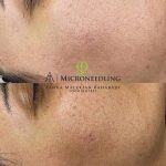 میکرونیدلینگ