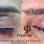 میکرونیدلینگ