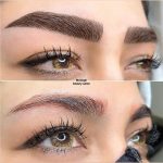 میکروبلیدینگ و فیبروز ابرو