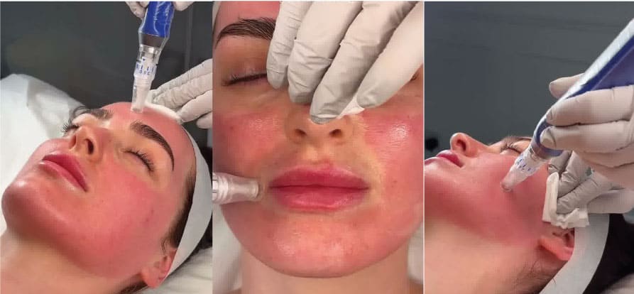 میکرونیدلینگ ۵