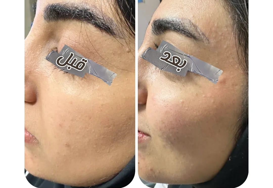 تزریق دو سی سی فیلر هیالورونیک اسید تزریق در ناحیه سیب گونه و کات گونه جهت کانتورینگ نچرال و لیفت صورت انجام شده دکتر رویا وطن خواه