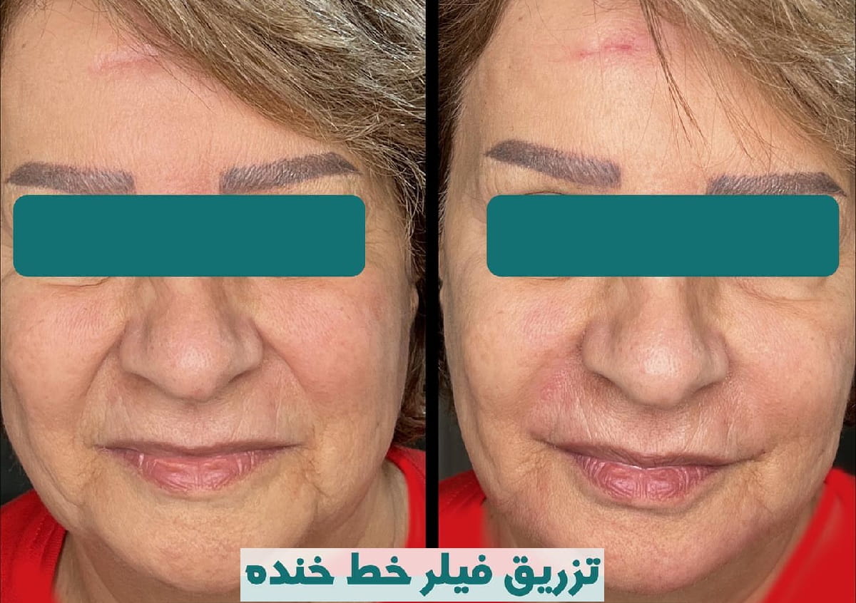 تزریق فیلر خط خنده و لیفت صورت با تزریق فیلر پزشک دکتر شروین ترابی