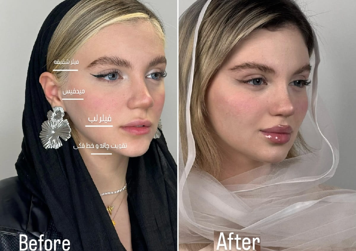 تکنیک تزریق Supra Ego 2 دکتر آریا تکنیک بی حسی موضعی