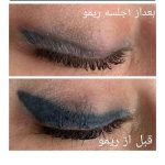 پاک کردن تتو