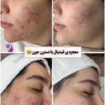 فیشیال صورت