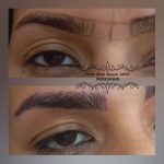 میکروبلیدینگ و فیبروز ابرو