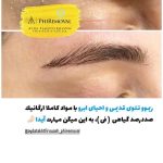 پاک کردن تتو
