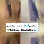 پاک کردن تتو