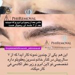 پاک کردن تتو