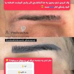 پاک کردن تتو