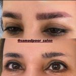 پاک کردن تتو